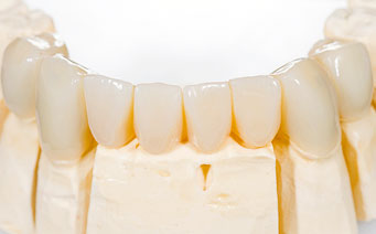 Fiksuoti dantų protezai, mikroprotezavimas ir paprastas protezavimas